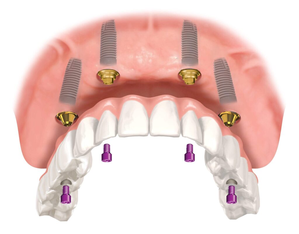 implant simani nedir 1